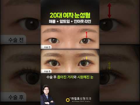 20대 여성의 매몰 + 앞트임 변화 썸네일 — 마침표TV