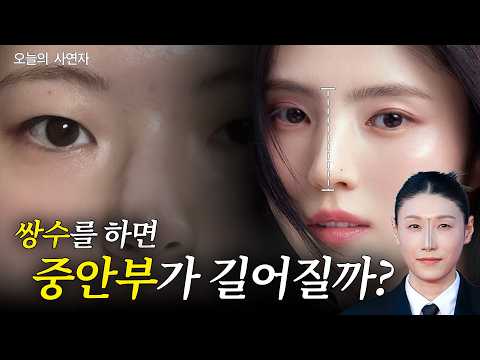 중안부가 길어질까 봐 쌍꺼풀 수술이 고민돼요. 썸네일 — 마침표TV