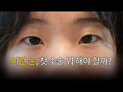첫 쌍수 전 가장 많이 묻는 4가지 질문｜앞트임·눈매교정·쌍꺼풀 라인·뒤밑트임 썸네일 — 마침표TV
