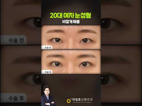 20대 여성의 비절개 매몰 눈성형 썸네일 — 마침표TV