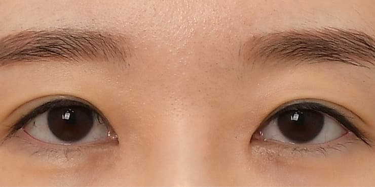 매몰재수술 — 수술 전 사진