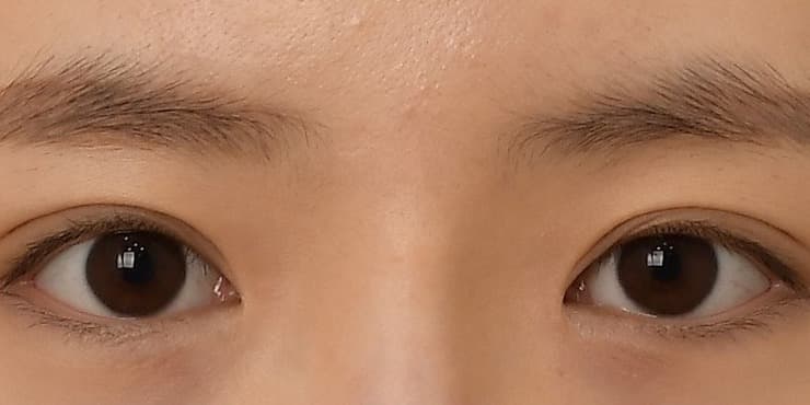 두줄따기(라인낮추기) — 수술 전 사진