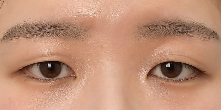 절개+눈매교정 — 수술 전 사진
