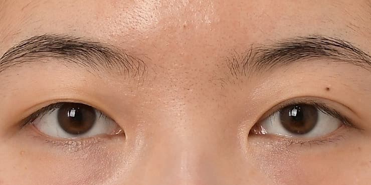 매몰+눈매교정 — 수술 전 사진