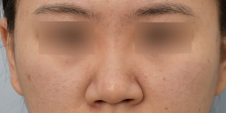 코성형 자연라인 — 수술 전 사진