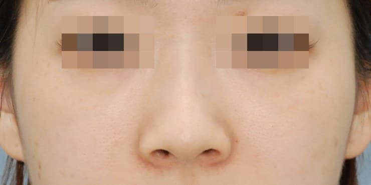 메부리+실리콘+코끝(자가연골) — 수술 전 사진