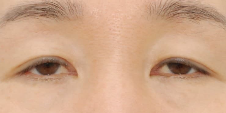 눈썹하거상 — 수술 전 사진