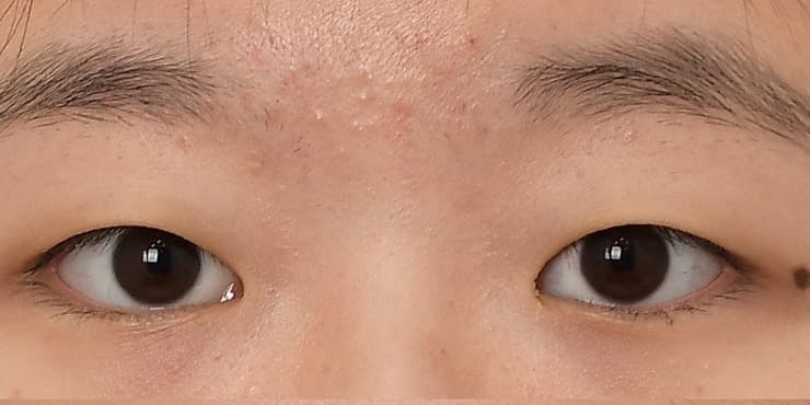 매몰+앞위트임 — 수술 전 사진