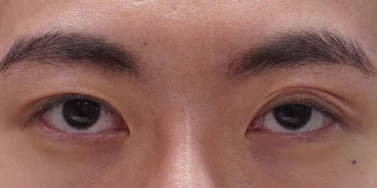 절개재수술+눈매교정 — 수술 전 사진