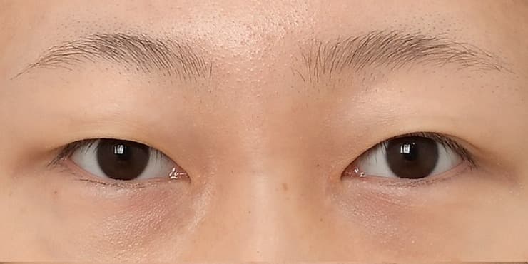 부분절개 자연라인 — 수술 전 사진
