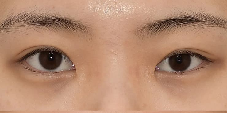 절개재수술 눈매교정 — 수술 전 사진
