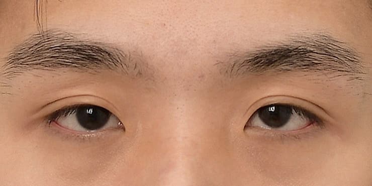 두줄따기(눈재수술) — 수술 전 사진