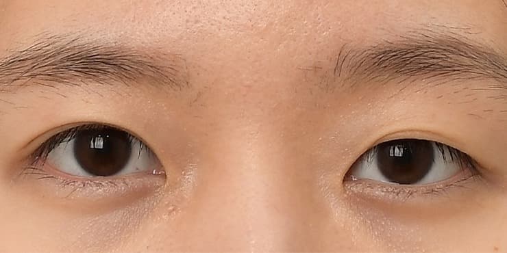 절개+눈매교정+앞위트임 — 수술 전 사진