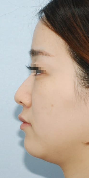 메부리 교정 측면라인 — 수술 전 사진