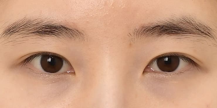 뒤밑트임 — 수술 전 사진