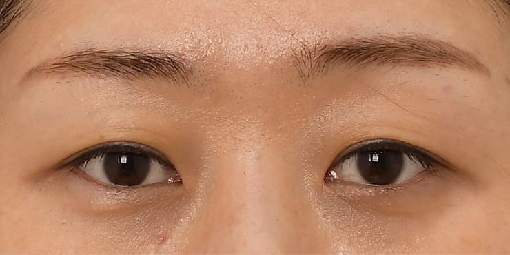 절개 풀패키지 — 수술 전 사진