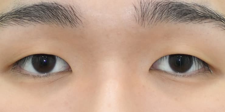 절개+눈매교정 — 수술 전 사진