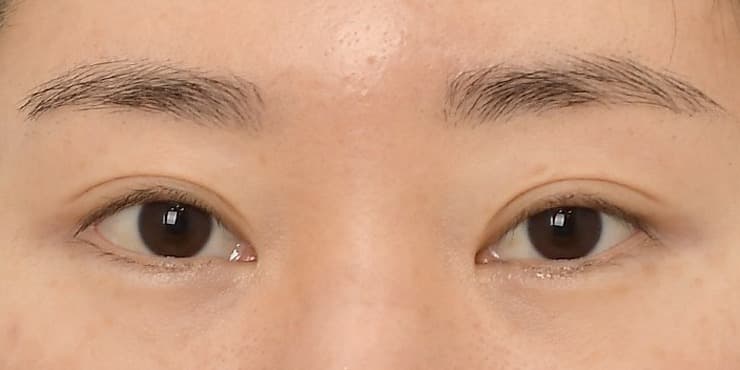 뒤밑트임 변형 — 수술 전 사진