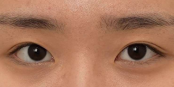 매몰법 자연쌍 — 수술 전 사진