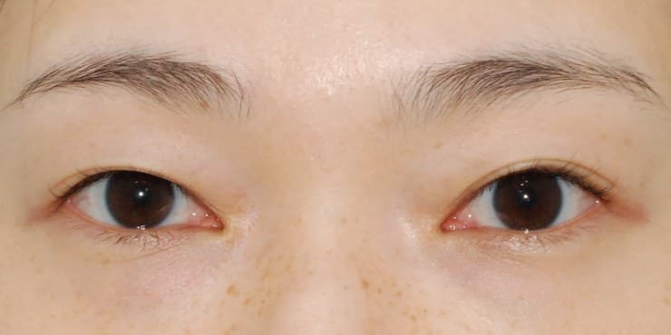 눈밑지방재배치 — 수술 전 사진