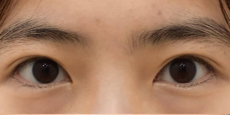 부분절개재수술+눈매교정 — 수술 전 사진