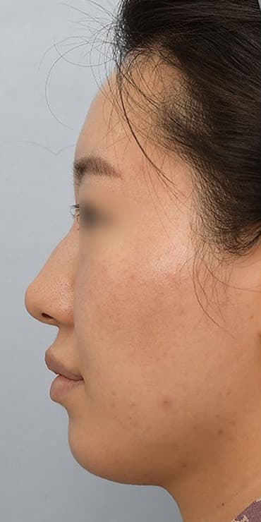 측면 콧대·코끝 — 수술 전 사진