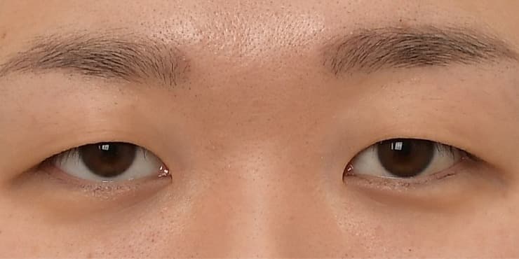 매몰+눈매교정 — 수술 전 사진