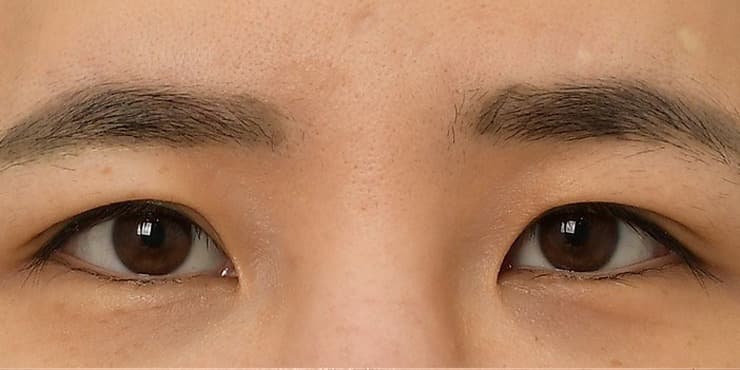 눈썹하거상+뒤밑트임 — 수술 전 사진