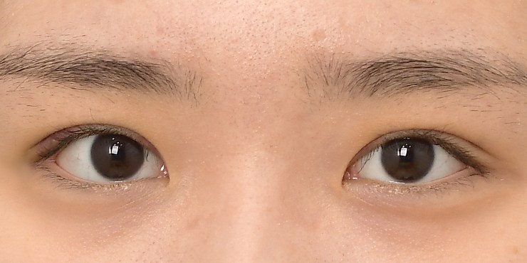 Eye surgery - After