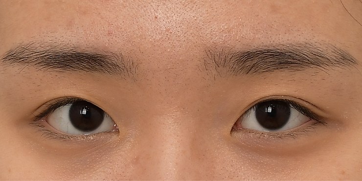 Eye surgery - Before