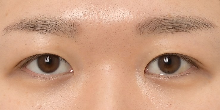 Eye surgery - After