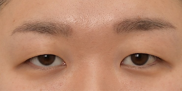 Eye surgery - Before
