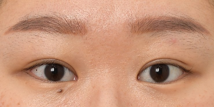 Eye surgery - After