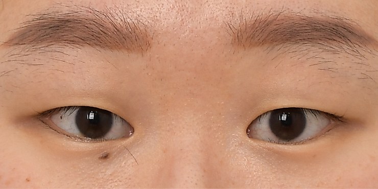 Eye surgery - Before