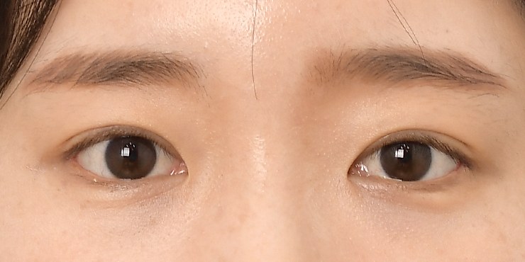 Eye surgery - After
