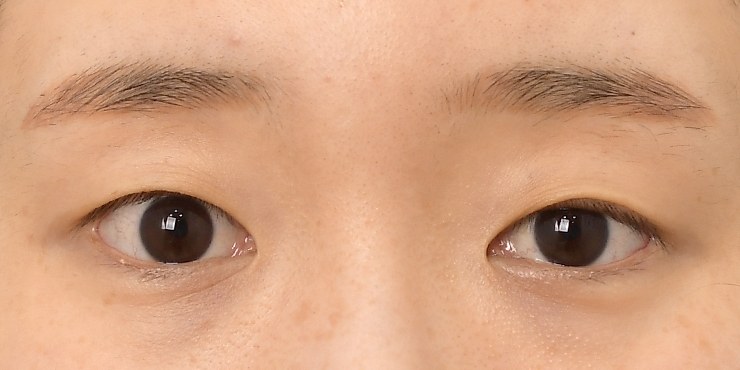 Eye surgery - Before