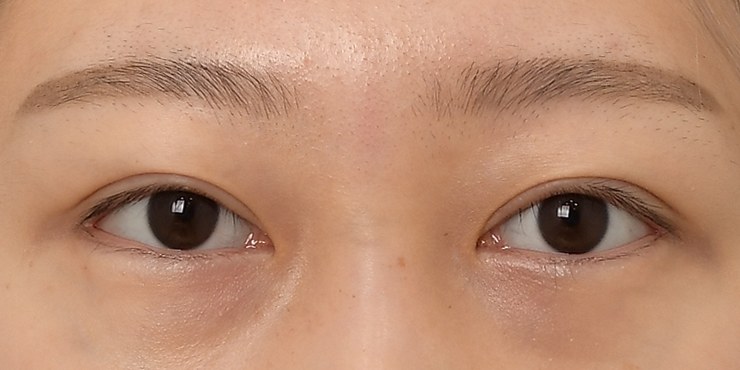 Eye surgery - After