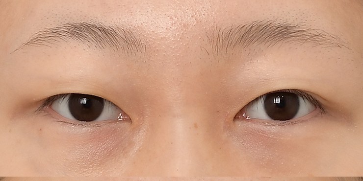Eye surgery - Before