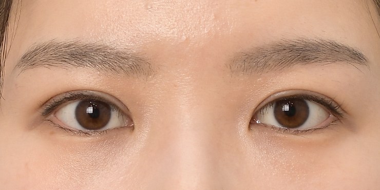 Eye surgery - After
