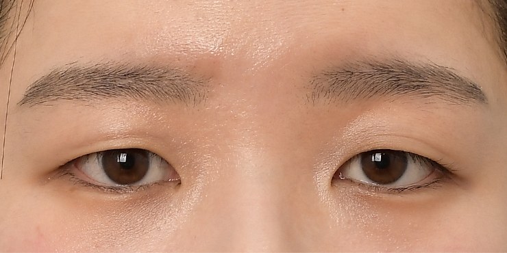 Eye surgery - Before