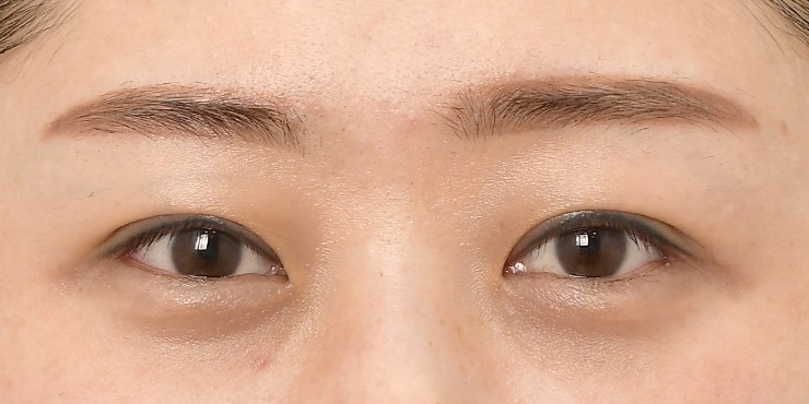 Eye surgery - After