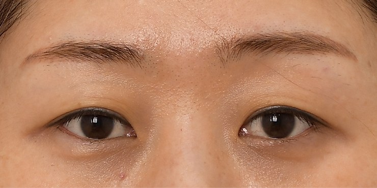 Eye surgery - Before