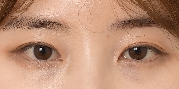 Eye surgery - After