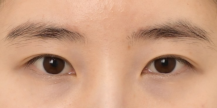 Eye surgery - Before
