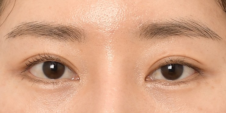 Eye surgery - After