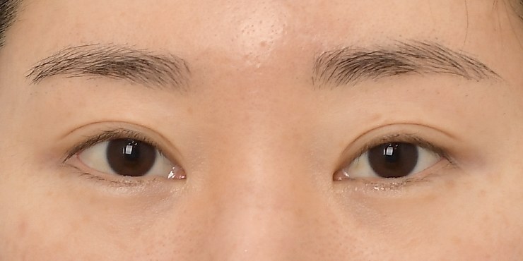 Eye surgery - Before