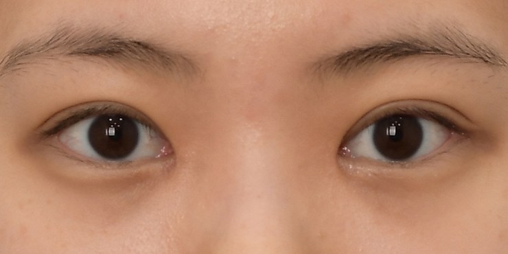 Eye surgery - After