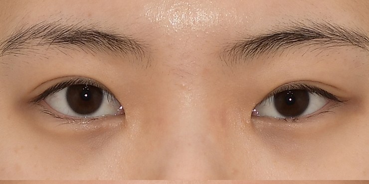 Eye surgery - Before