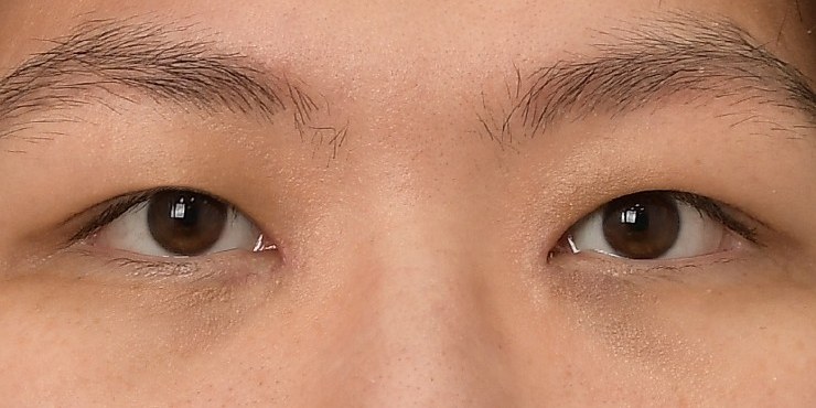 Eye surgery - After