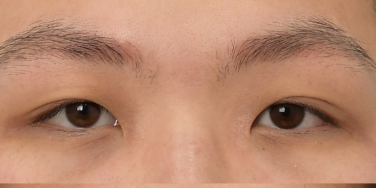 Eye surgery - Before